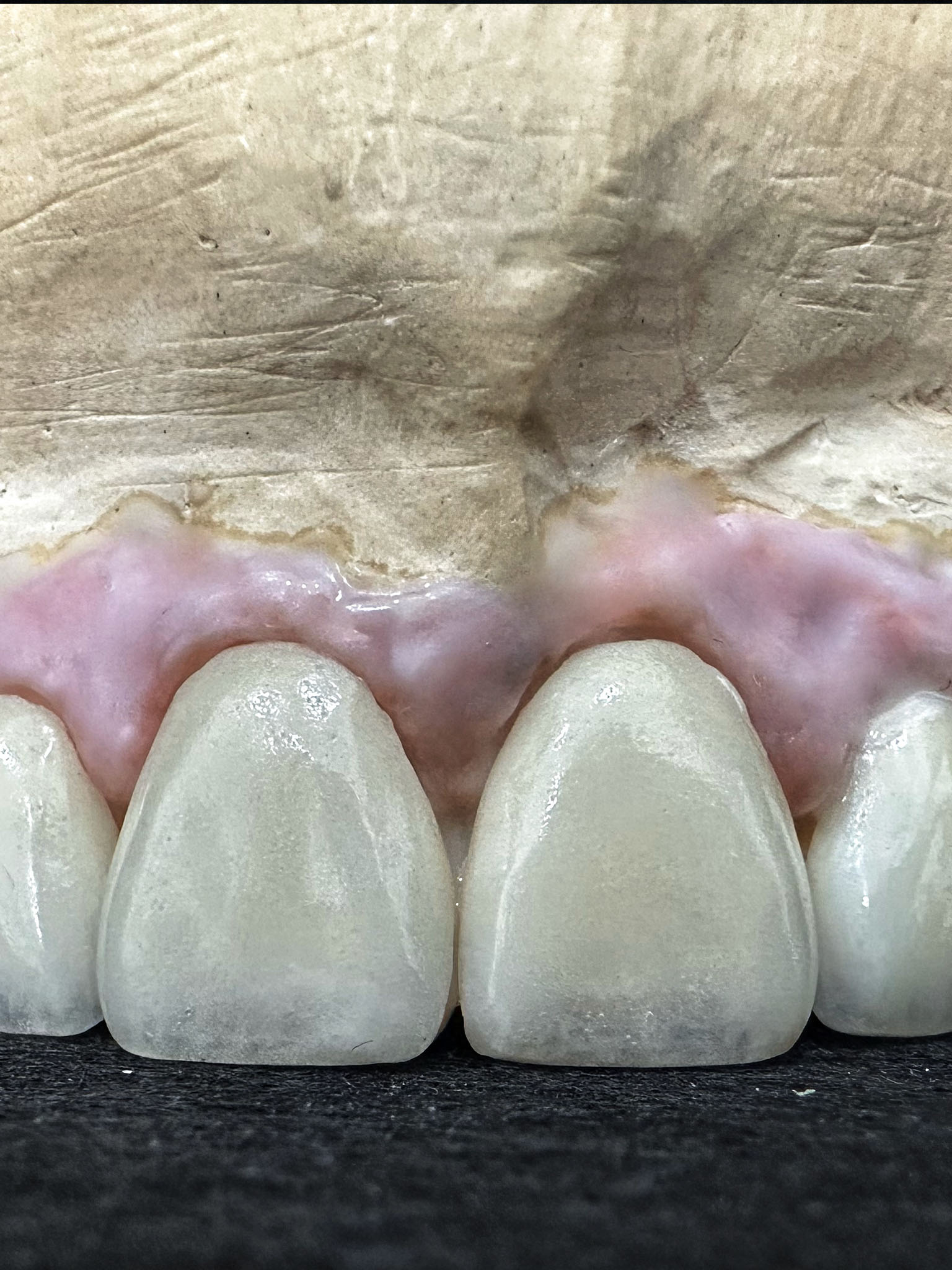 ESTÉTICA Y CARILLAS DENTALES  MURCIA